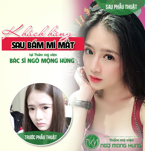 Bấm mí bao lâu thì đẹp