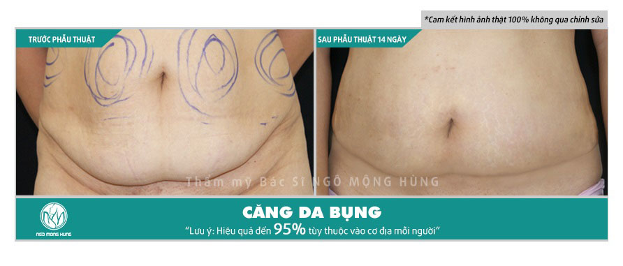Hình ảnh trước và sau khi căng da bụng