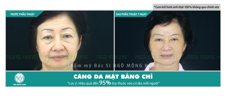 Căng da mặt bằng chỉ collagen