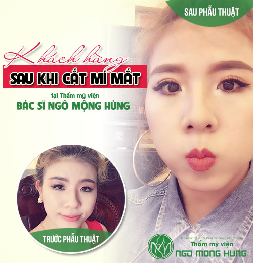 Cắt da thừa mí mắt dưới