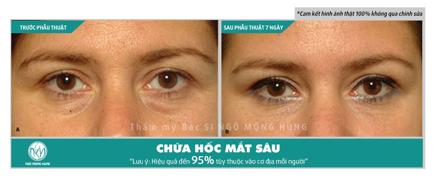 Hốc mắt sâu