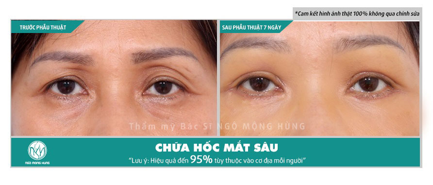 Trang điểm cho hốc mắt sâu