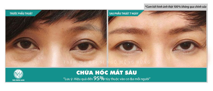 Điều trị hốc mắt sâu