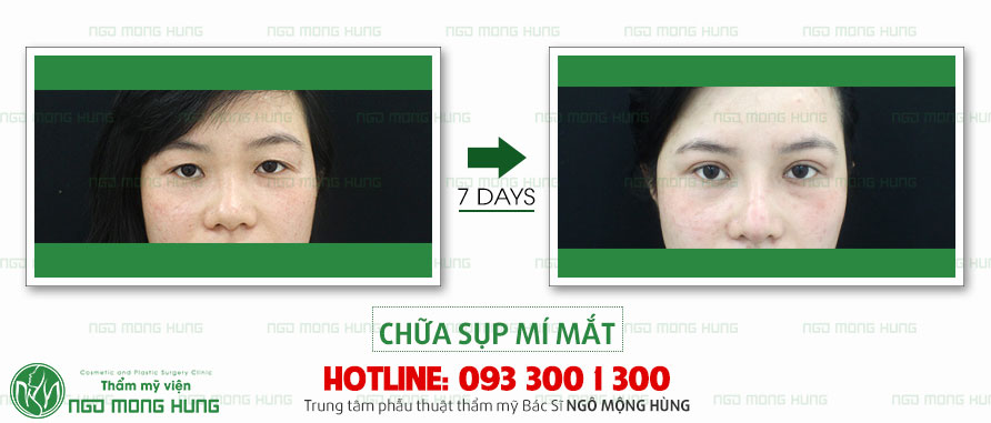 chua-sup-mi-mat-3.jpg