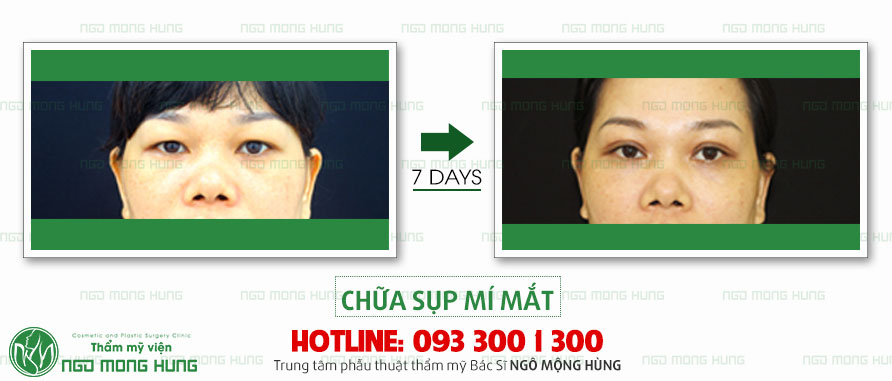 chua-sup-mi-mat-4.jpg