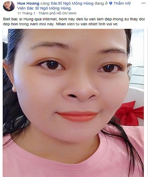Hút mỡ hai bên má