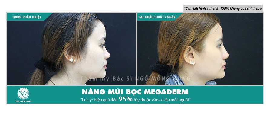 Hình ảnh trước và sau khi phẫu thuật nâng mũi