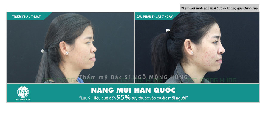 Nâng mũi Hàn Quốc