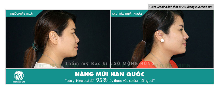 Nâng mũi Hàn Quốc bằng sụn tự thân