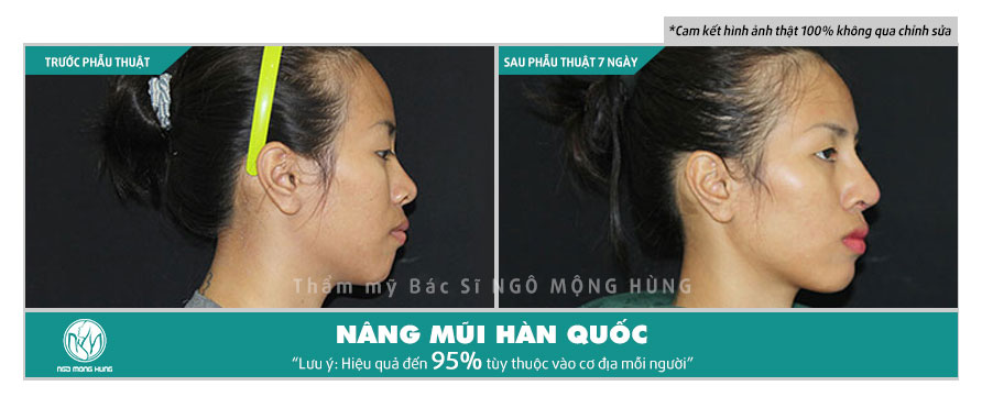 Nâng mũi bằng chỉ Hàn Quốc