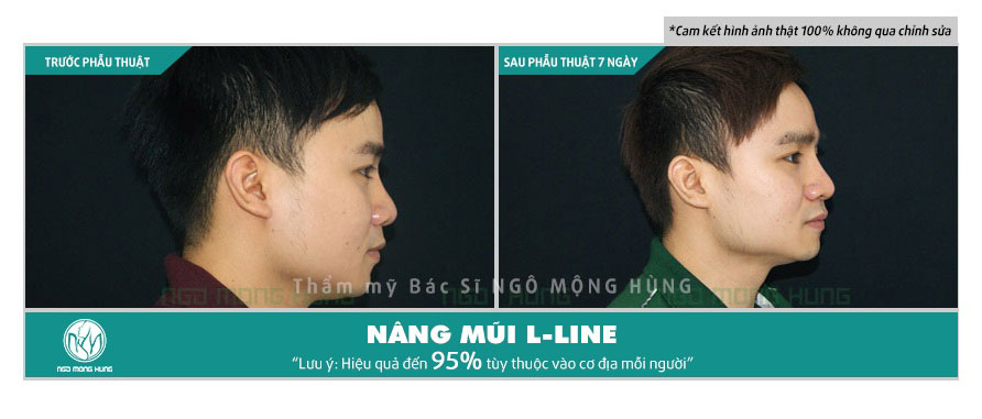 Tham khảo hình ảnh nâng mũi bằng sụn tự thân Nang-mui-l-line-2