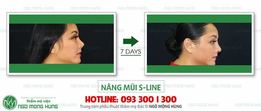 Tham khảo diễn đàn thẩm mỹ nâng mũi uy tín Nang-mui-s-line-1