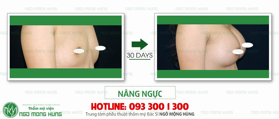 Thực hư chuyện kem nở ngực an toàn và hiệu quả  Nang-nguc-2