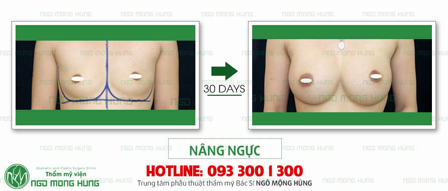 Sở hữu bầu ngực TĂNG SIZE quyến rũ sau khi nâng ngực tại Bệnh viện thẩm mỹ Ngô Mộng Hùng 