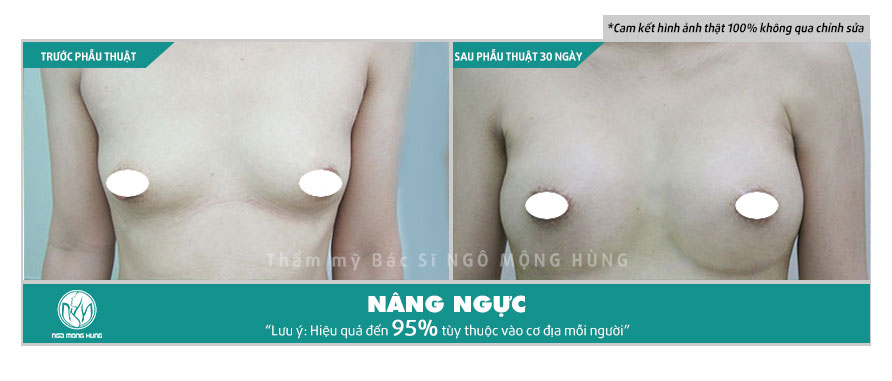 Thực sự kem nở ngực có an toàn không? Những điều các tín đồ làm đẹp nên biết Nang-nguc-bang-mo-tu-than-1
