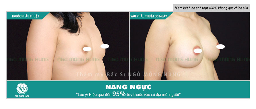 Clip nâng ngực bằng mỡ tự thân giá bao nhiêu?