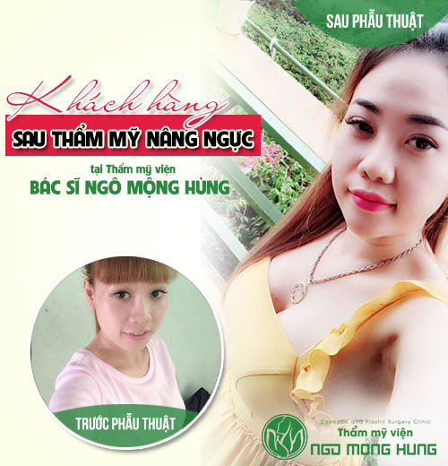 Vì sao ngực bị chảy xệ