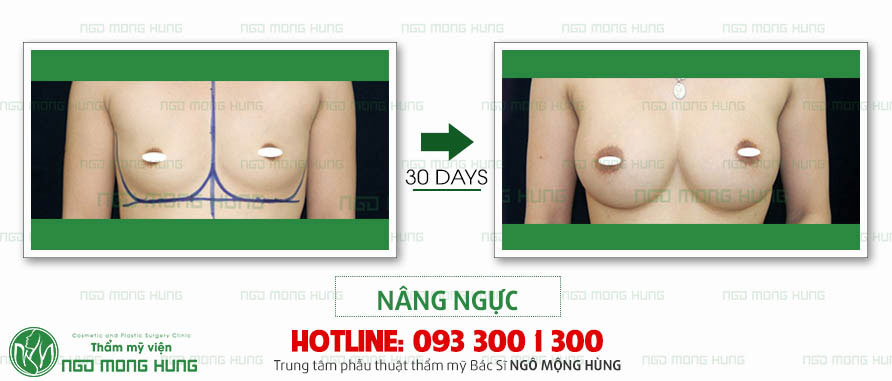 nâng ngực nội soi