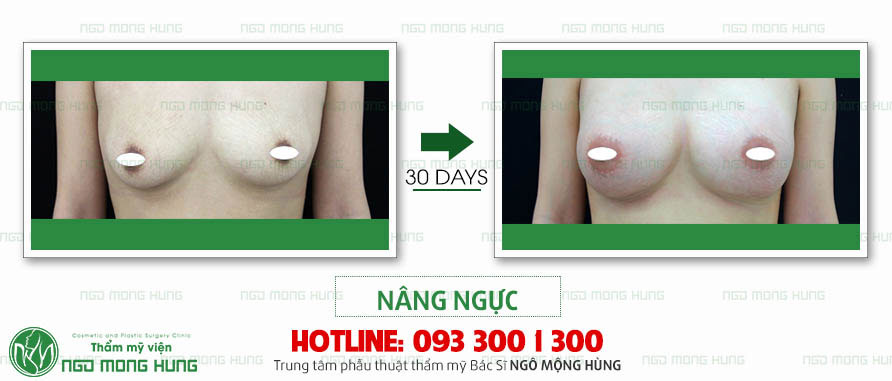 Nâng ngực nội soi tại Hà Nội