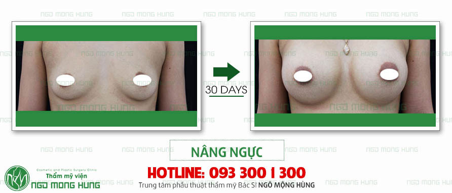 Giá nâng ngực tại Hà Nội
