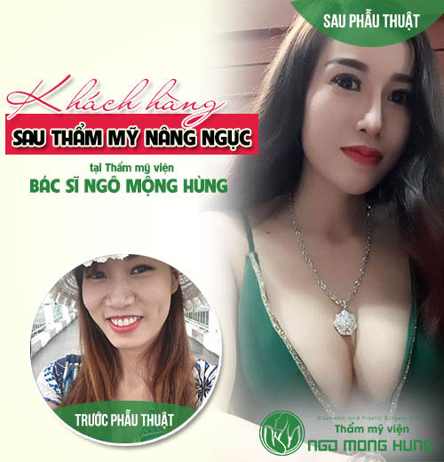 Video phẫu thuật ngực nội soi