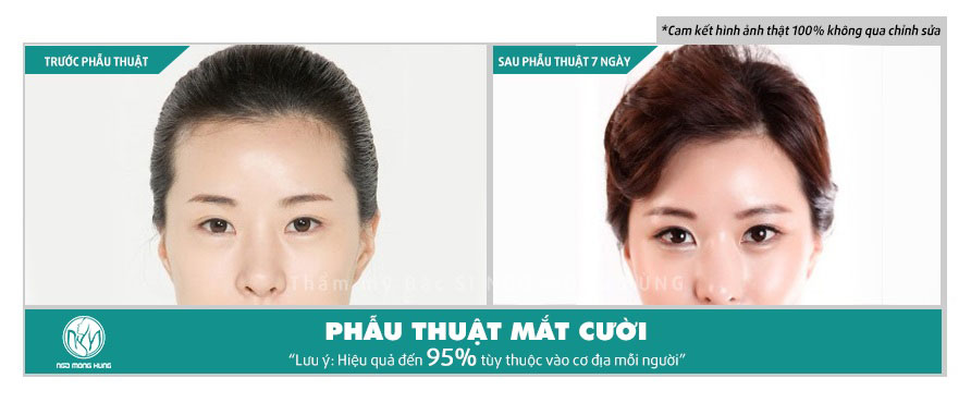 Phẫu thuật mắt cười