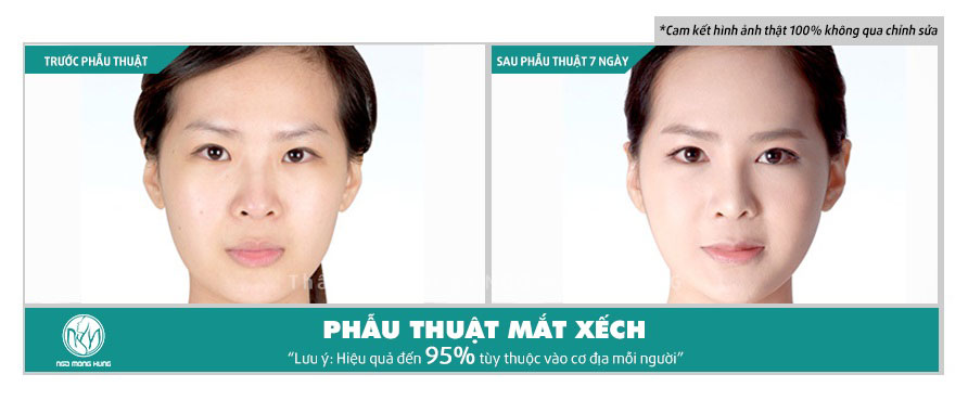 Phẫu thuật mắt xếch