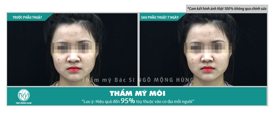 Phẫu thuật thẩm mỹ môi ở Hà Nội