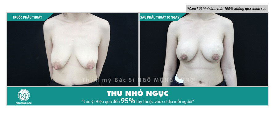 Bệnh viện thẩm mỹ Ngô Mộng Hùng - Địa chỉ thu nhỏ ngực HIỆU QUẢ - UY TÍN - CHẤT LƯỢNG hàng đầu 