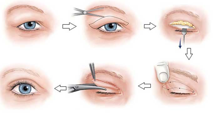 Cách chữa bệnh sụp mí mắt