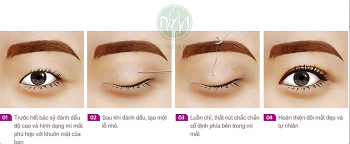 Chuyên gia thẩm mỹ giải đáp: Bấm mí Dove Eyes là gì?