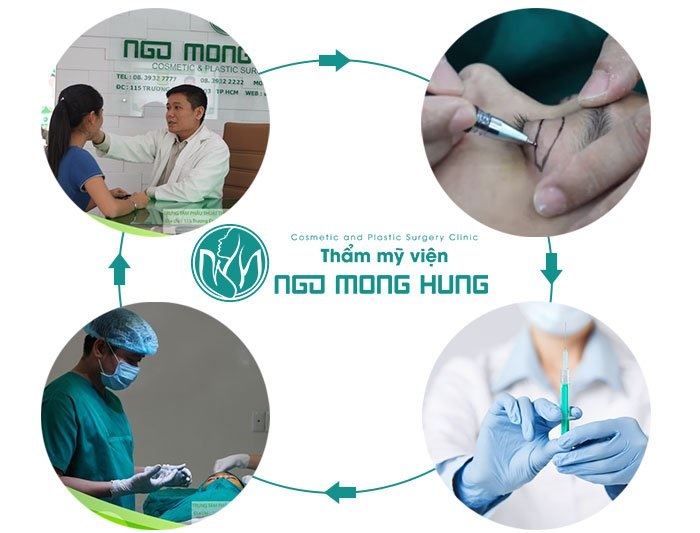 Cắt và nâng mí mắt