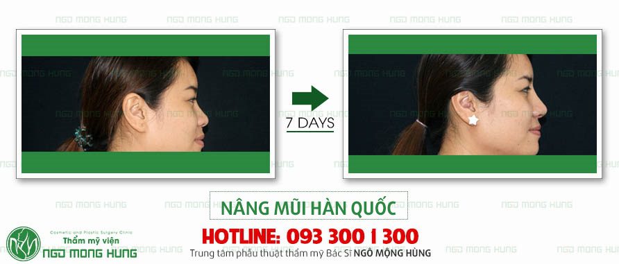 Nâng mũi bằng sụn tự thân Nâng mũi bằng sụn tự thân