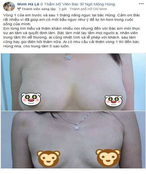 Giá nâng ngực tại Hà Nội