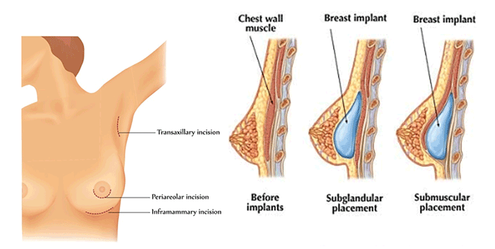 Nâng ngực bằng breast fit system