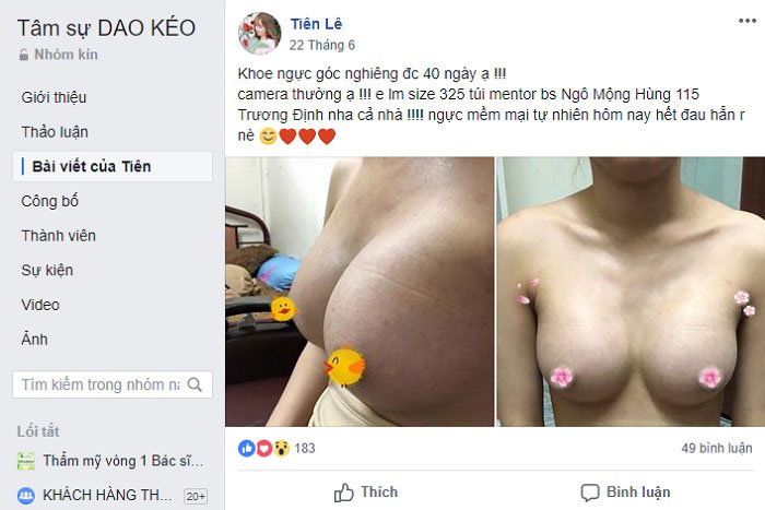 Bệnh viện thẩm mỹ Ngô Mộng Hùng phẫu thuật nâng ngực có ảnh hưởng gì không Phau-thuat-nang-nguc-co-anh-huong-gi-khong-14