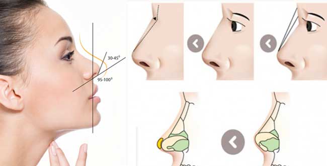 Nâng mũi không phẫu thuật bằng aquamid
