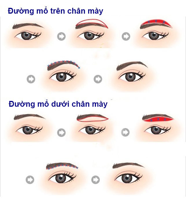 Treo chân mày bằng chỉ Treo chân mày bằng chỉ