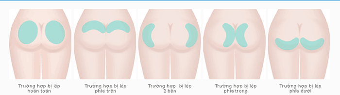 Quần độn mông nữ TPHCM