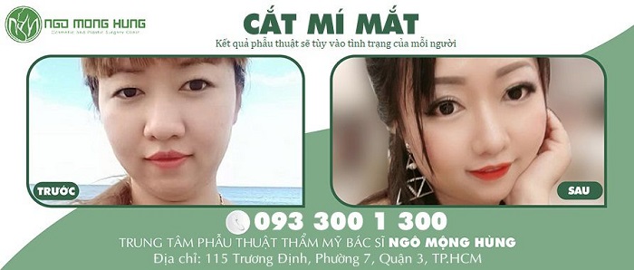 Quá trình cắt mí mắt của khách hàng Huỳnh Thị Thanh Hằng