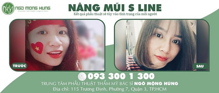 Bật mí lí do cô gái sống tại Hà Nội lại chọn nâng mũi Sline ở Sài Gòn
