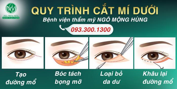 thẩm mỹ cắt mí dưới