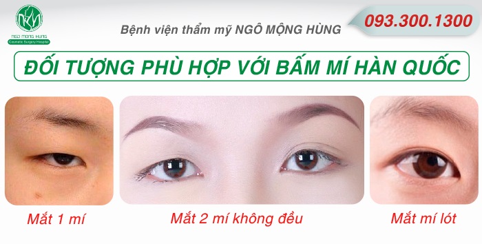 Bấm mí Hàn Quốc ở TP.HCM| Bệnh viện Ngô Mộng Hùng Doi-tuong-bam-mi