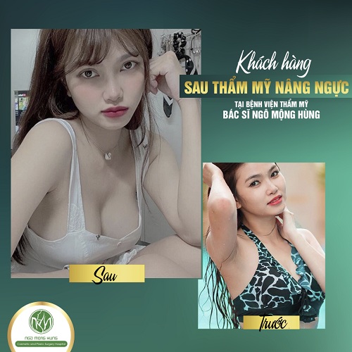 Nâng ngực an toàn ở Hà Nội