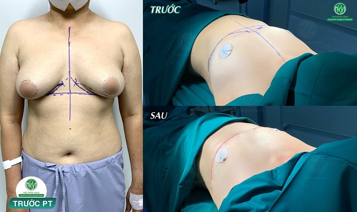 Phẫu thuật cắt bỏ ngực 
