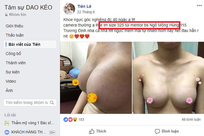 Đánh giá thực tế của các khách hàng sau khi nâng ngực tại Bệnh viện thẩm mỹ Ngô Mộng Hùng 