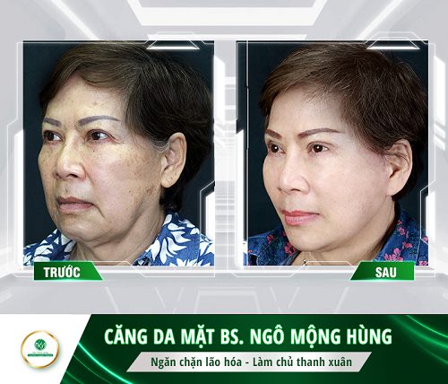 Toàn quốc - Những lưu ý khi căng chỉ da mặt full face 5-19