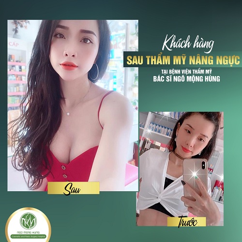 Thẩm mỹ mắt ở đâu tốt nhất? Bệnh viện Ngô Mộng Hùng  Selfie-nang-nguc-2-8