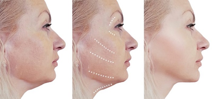 Mẹo vặt làm đẹp: Chăm sóc da mặt sau khi bắn laser như thế nào là đúng cách? 26-3