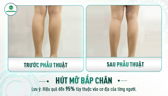 Review hút mỡ bắp chân